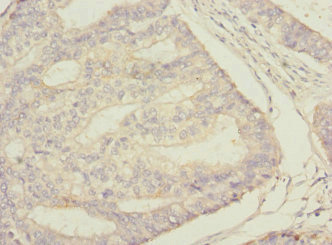 Immunohistochemistry of paraffin-embedded human endometrial cancer using CSB-PA022793ESR2HU at dilution of 1:100