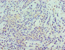 Immunohistochemistry of paraffin-embedded human breast cancer using CSB-PA022815ESR1HU at dilution of 1:100