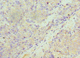 Immunohistochemistry of paraffin-embedded human colon cancer using CSB-PA022933ESR1HU at dilution of 1:100 Immunohistochemistry of paraffin-embedded human colon cancer using CSB-PA022933ESR1HU at dilution of 1:100