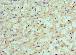 Immunohistochemistry of paraffin-embedded human liver cancer using CSB-PA022942ESR1HU at dilution of 1:100 Immunohistochemistry of paraffin-embedded human liver cancer using CSB-PA022942ESR1HU at dilution of 1:100