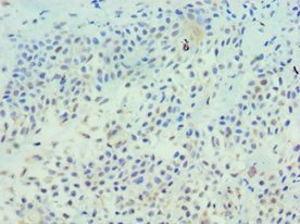 Immunohistochemistry of paraffin-embedded human breast cancer using CSB-PA023431DSR2HU at dilution of 1:100 Immunohistochemistry of paraffin-embedded human breast cancer using CSB-PA023431DSR2HU at dilution of 1:100