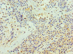 Immunohistochemistry of paraffin-embedded human breast cancer using CSB-PA023438DSR1HU at dilution of 1:100 Immunohistochemistry of paraffin-embedded human breast cancer using CSB-PA023438DSR1HU at dilution of 1:100