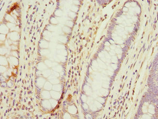 Immunohistochemistry of paraffin-embedded human colon cancer using CSB-PA023655ESR2HU at dilution of 1:100