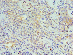 Immunohistochemistry of paraffin-embedded human breast cancer using CSB-PA023989ESR1HU at dilution of 1:100