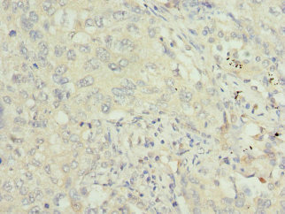 Immunohistochemistry of paraffin-embedded human lung cancer using CSB-PA024152ESR1HU at dilution of 1:100 Immunohistochemistry of paraffin-embedded human lung cancer using CSB-PA024152ESR1HU at dilution of 1:100