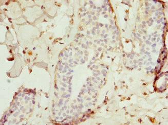 Immunohistochemistry of paraffin-embedded human breast cancer using CSB-PA024152ESR1HU at dilution of 1:100