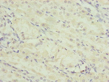 Immunohistochemistry of paraffin-embedded human gastric cancer using CSB-PA024459ESR1HU at dilution of 1:100