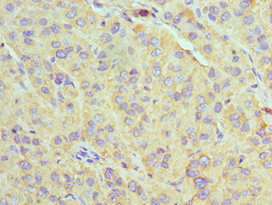 Immunohistochemistry of paraffin-embedded human liver cancer using CSB-PA025405ESR1HU at dilution of 1:100 Immunohistochemistry of paraffin-embedded human liver cancer using CSB-PA025405ESR1HU at dilution of 1:100