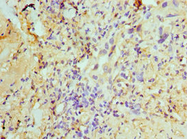 Immunohistochemistry of paraffin-embedded human lung cancer using CSB-PA025405ESR1HU at dilution of 1:100