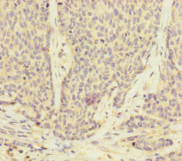 Immunohistochemistry of paraffin-embedded human ovarian cancer using CSB-PA025409ESR1HU at dilution of 1:100