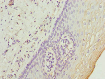 Immunohistochemistry of paraffin-embedded human cervical cancer using CSB-PA025587ESR1HU at dilution of 1:100 Immunohistochemistry of paraffin-embedded human cervical cancer using CSB-PA025587ESR1HU at dilution of 1:100