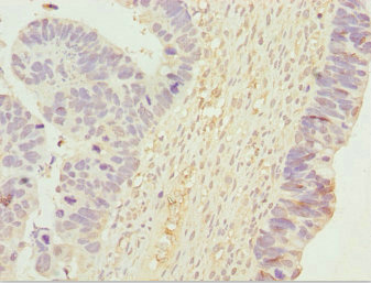 Immunohistochemistry of paraffin-embedded human ovarian cancer using CSB-PA025587ESR1HU at dilution of 1:100