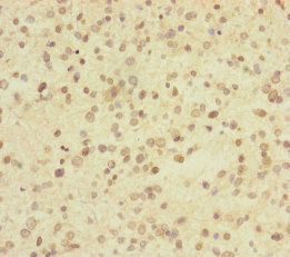 Immunohistochemistry of paraffin-embedded human glioma using CSB-PA025710ESR1HU at dilution of 1:100