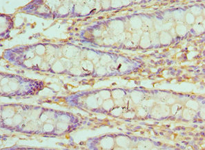 Immunohistochemistry of paraffin-embedded human colon cancer using CSB-PA025855ESR1HU at dilution of 1:100 Immunohistochemistry of paraffin-embedded human colon cancer using CSB-PA025855ESR1HU at dilution of 1:100