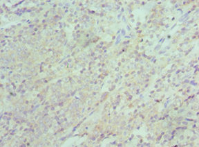 Immunohistochemistry of paraffin-embedded human colon cancer using CSB-PA026193ESR2HU at dilution of 1:100