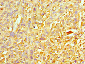 Immunohistochemistry of paraffin-embedded human melanoma using CSB-PA026193ESR2HU at dilution of 1:100