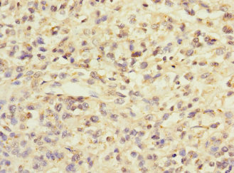 Immunohistochemistry of paraffin-embedded human melanoma using CSB-PA026486ESR2HU at dilution of 1:100 Immunohistochemistry of paraffin-embedded human melanoma using CSB-PA026486ESR2HU at dilution of 1:100