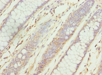 Immunohistochemistry of paraffin-embedded human colon cancer using CSB-PA026553ESR1HU at dilution of 1:100