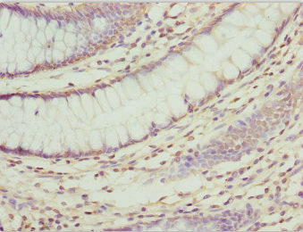 Immunohistochemistry of paraffin-embedded human colon cancer using CSB-PA026553ESR2HU at dilution of 1:100