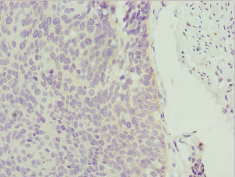 Immunohistochemistry of paraffin-embedded human cervical cancer using CSB-PA026565ESR1HU at dilution of 1:100 Immunohistochemistry of paraffin-embedded human cervical cancer using CSB-PA026565ESR1HU at dilution of 1:100