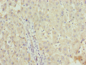 Immunohistochemistry of paraffin-embedded human liver cancer using CSB-PA026613ESR1HU at dilution of 1:100 Immunohistochemistry of paraffin-embedded human liver cancer using CSB-PA026613ESR1HU at dilution of 1:100