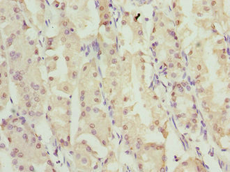 Immunohistochemistry of paraffin-embedded human gastric cancer using CSB-PA026830ESR2HU at dilution of 1:100