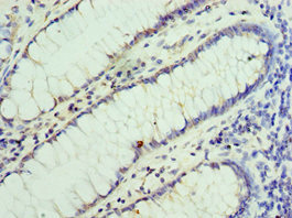 Immunohistochemistry of paraffin-embedded human colon cancer using CSB-PA528513DSR2HU at dilution of 1:100