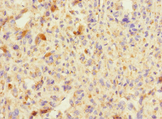 Immunohistochemistry of paraffin-embedded human melanoma using CSB-PA617924ESR2HU at dilution of 1:100