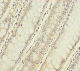 Immunohistochemistry of paraffin-embedded human colon cancer using CSB-PA617948ESR1HU at dilution of 1:100