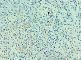 Immunohistochemistry of paraffin-embedded human breast cancer using CSB-PA618018ESR1HU at dilution of 1:100