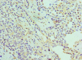 Immunohistochemistry of paraffin-embedded human breast cancer using CSB-PA618074ESR1HU at dilution of 1:100 Immunohistochemistry of paraffin-embedded human breast cancer using CSB-PA618074ESR1HU at dilution of 1:100