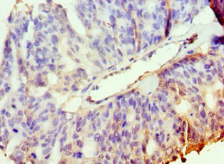 Immunohistochemistry of paraffin-embedded human endometrial cancer using CSB-PA622641DSR1HU at dilution of 1:100