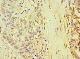 Immunohistochemistry of paraffin-embedded human endometrial cancer using CSB-PA623007ESR1HU at dilution of 1:100