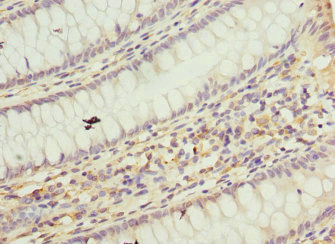 Immunohistochemistry of paraffin-embedded human colon cancer using CSB-PA624102ESR1HU at dilution of 1:100