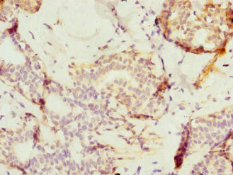 Immunohistochemistry of paraffin-embedded human breast cancer using CSB-PA624102ESR1HU at dilution of 1:100