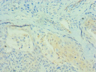Immunohistochemistry of paraffin-embedded human breast cancer using CSB-PA703610DSR2HU at dilution of 1:100