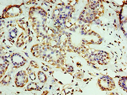 Immunohistochemistry of paraffin-embedded human breast cancer using CSB-PA726123ESR1HU at dilution of 1:100 Immunohistochemistry of paraffin-embedded human breast cancer using CSB-PA726123ESR1HU at dilution of 1:100