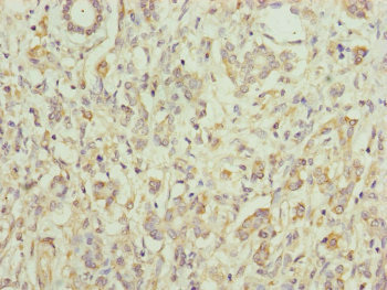 Immunohistochemistry of paraffin-embedded human pancreatic cancer using CSB-PA745333DSR1HU at dilution of 1:100