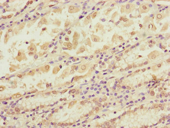 Immunohistochemistry of paraffin-embedded human gastric cancer using CSB-PA754307ESR1HU at dilution of 1:100