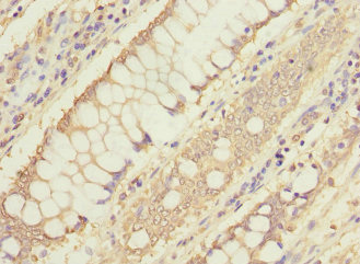 Immunohistochemistry of paraffin-embedded human colon cancer using CSB-PA754385ESR2HU at dilution of 1:100