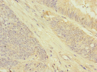 Immunohistochemistry of paraffin-embedded human colon cancer using CSB-PA819443ESR1HU at dilution of 1:100