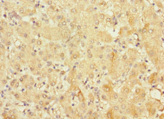 Immunohistochemistry of paraffin-embedded human liver cancer using CSB-PA822270ESR2HU at dilution of 1:100 Immunohistochemistry of paraffin-embedded human liver cancer using CSB-PA822270ESR2HU at dilution of 1:100