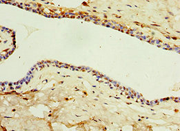 Immunohistochemistry of paraffin-embedded human breast cancer using CSB-PA822717ESR2HU at dilution of 1:100