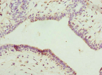 Immunohistochemistry of paraffin-embedded human breast cancer using CSB-PA850247ESR1HU at dilution of 1:100