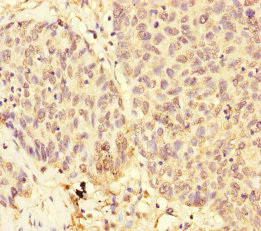 Immunohistochemistry of paraffin-embedded human ovarian cancer using CSB-PA850427ESR1HU at dilution of 1:100