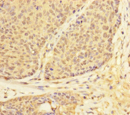 Immunohistochemistry of paraffin-embedded human ovarian cancer using CSB-PA850427ESR2HU at dilution of 1:100