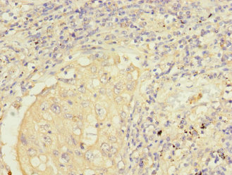 Immunohistochemistry of paraffin-embedded human lung cancer using CSB-PA857449ESR1HU at dilution of 1:100