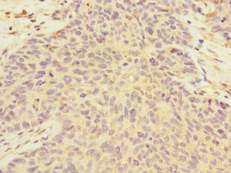 Immunohistochemistry of paraffin-embedded human ovarian cancer using CSB-PA857449ESR1HU at dilution of 1:100