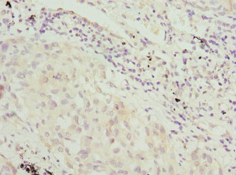 Immunohistochemistry of paraffin-embedded human lung cancer using CSB-PA857466DSR1HU at dilution of 1:100