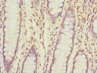 Immunohistochemistry of paraffin-embedded human colon cancer using CSB-PA860770ESR1HU at dilution of 1:100